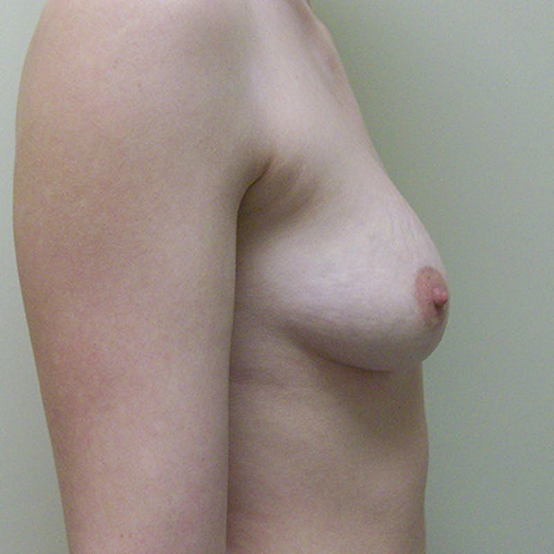 Saline Breast Augmentation Before & After Gallery - Patient 154948718 - Image 3