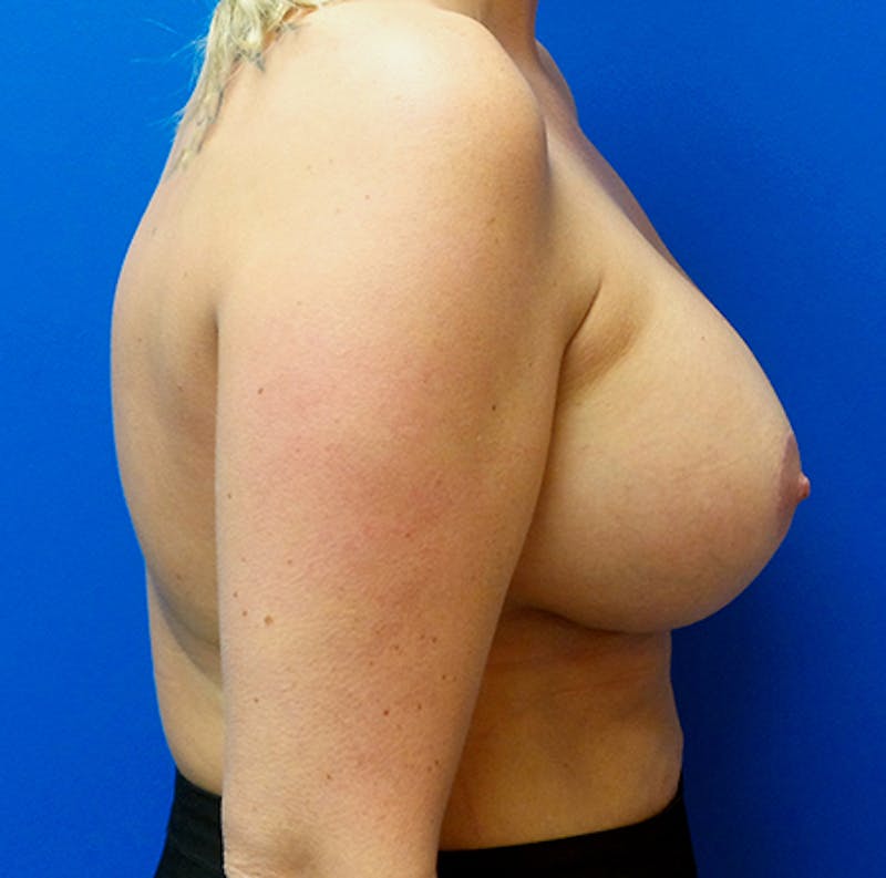 Augmentation Mastopexy Before & After Gallery - Patient 154948727 - Image 4