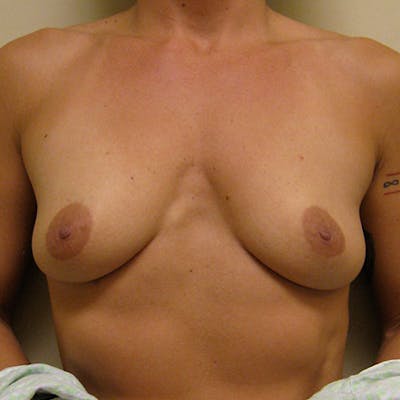 Transaxillary Breast Augmentation Before & After Gallery - Patient 154948729 - Image 1
