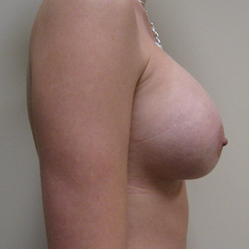 Saline Breast Augmentation Before & After Gallery - Patient 154948718 - Image 4