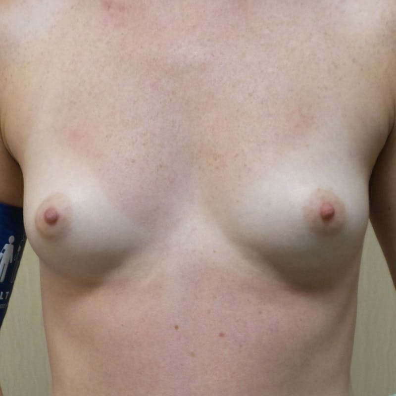 Silicone Breast Augmentation Before & After Gallery - Patient 154948726 - Image 1