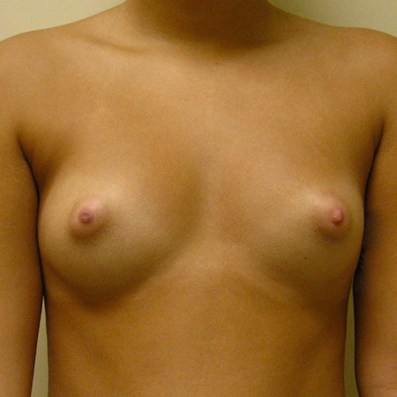 Saline Breast Augmentation Before & After Gallery - Patient 154948725 - Image 1