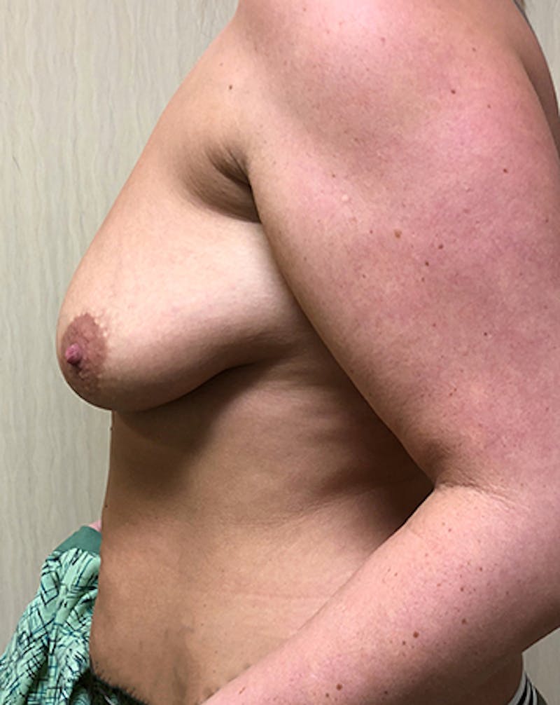 Augmentation Mastopexy Before & After Gallery - Patient 154948727 - Image 7