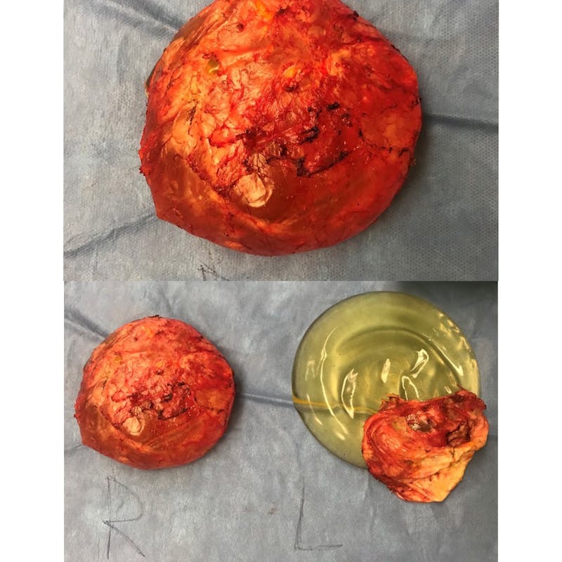 Breast Implant Removal Before & After Gallery - Patient 154948723 - Image 2