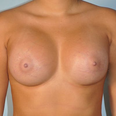 Saline Breast Augmentation Before & After Gallery - Patient 154948725 - Image 2