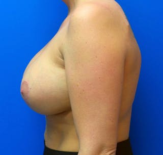 Augmentation Mastopexy Before & After Gallery - Patient 154948727 - Image 8