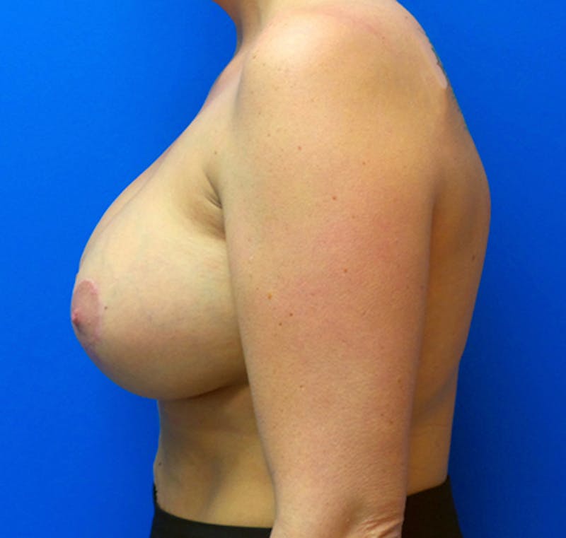 Augmentation Mastopexy Before & After Gallery - Patient 154948727 - Image 8