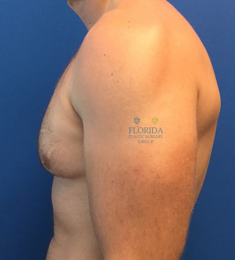 Male Breast Reduction Before & After Gallery - Patient 154948730 - Image 5