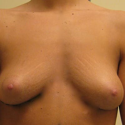 Saline Breast Augmentation Before & After Gallery - Patient 154948732 - Image 1