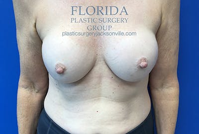 Breast Implant Removal Before & After Gallery - Patient 154948731 - Image 1