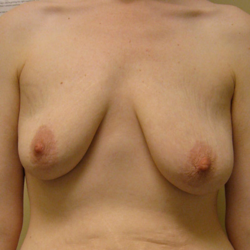 Breast Lift Before & After Gallery - Patient 154948738 - Image 1