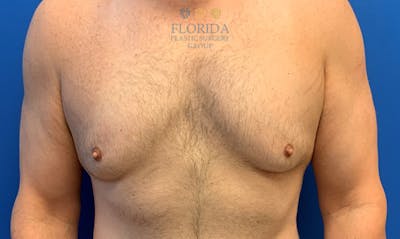 Male Breast Reduction Before & After Gallery - Patient 154948734 - Image 1