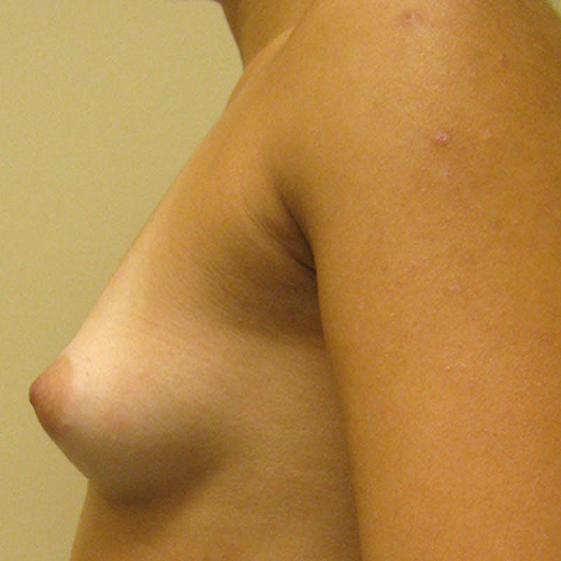 Transaxillary Breast Augmentation Before & After Gallery - Patient 154948733 - Image 3