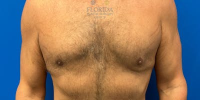 Male Breast Reduction Before & After Gallery - Patient 154948734 - Image 2