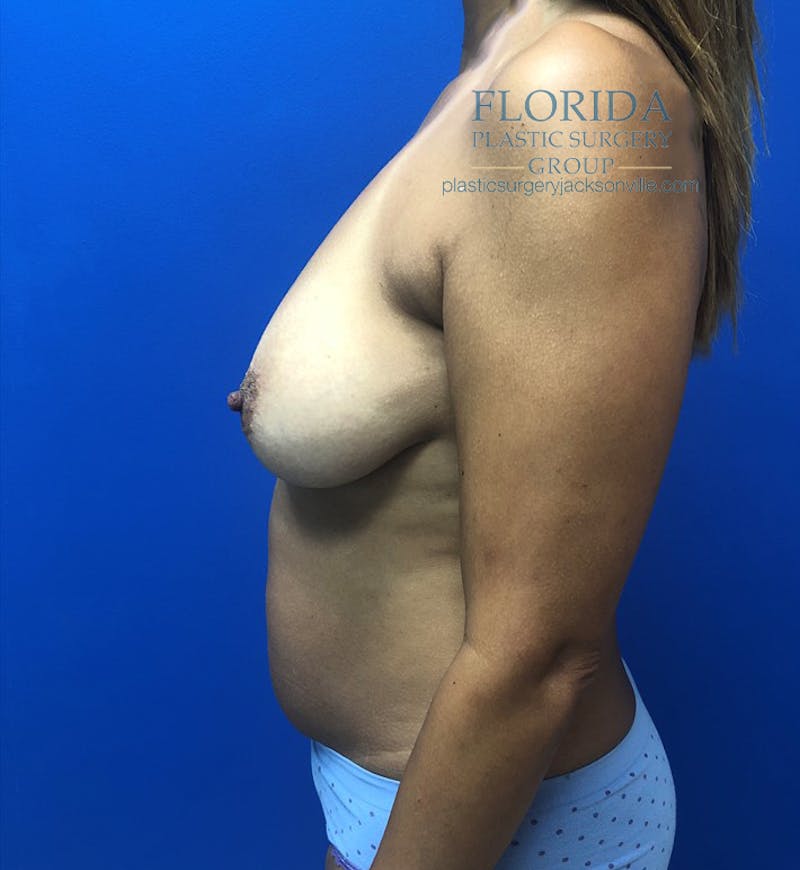 Augmentation Mastopexy Before & After Gallery - Patient 154948739 - Image 3
