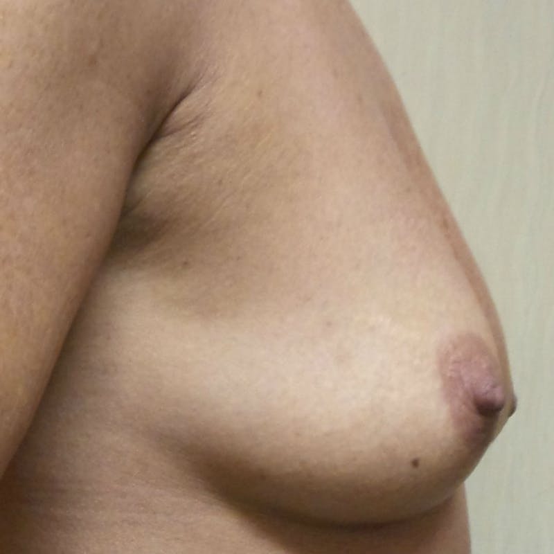 Silicone Breast Augmentation Before & After Gallery - Patient 154948740 - Image 5