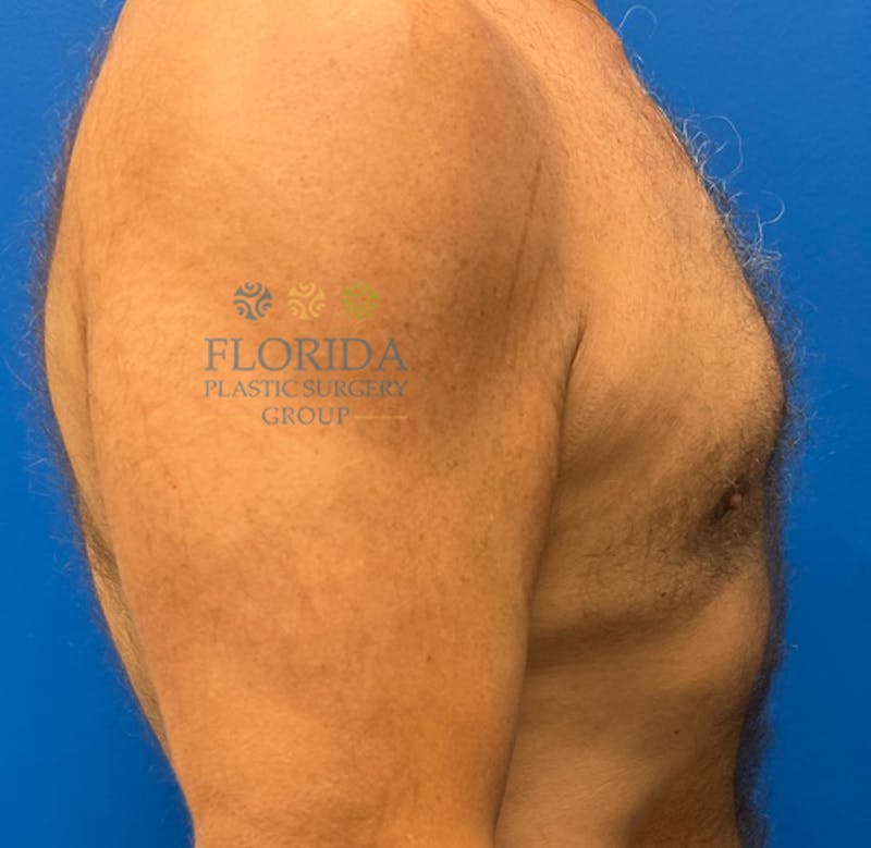 Male Breast Reduction Before & After Gallery - Patient 154948734 - Image 4