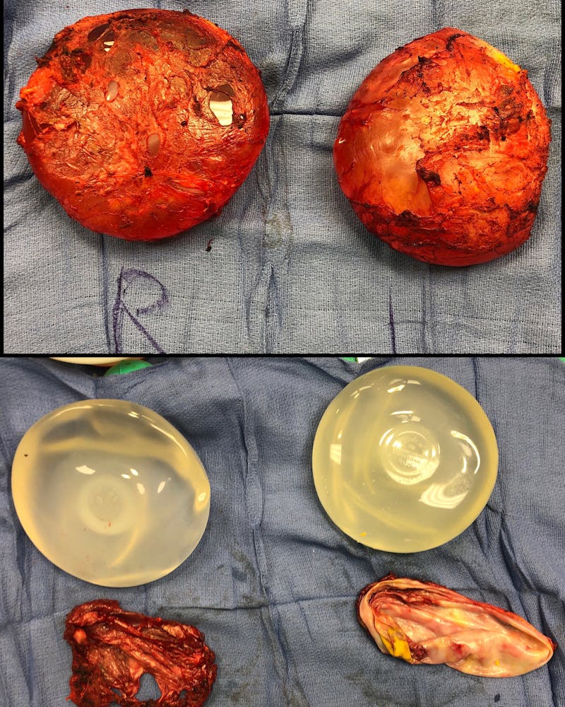 Breast Implant Removal Before & After Gallery - Patient 154948736 - Image 2