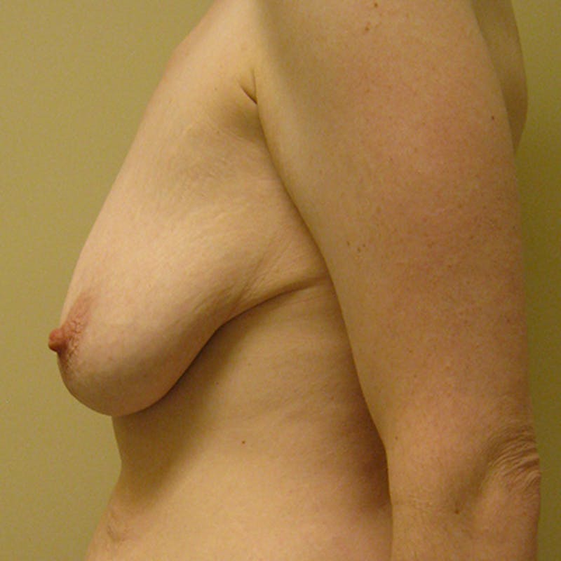 Breast Lift Before & After Gallery - Patient 154948738 - Image 5