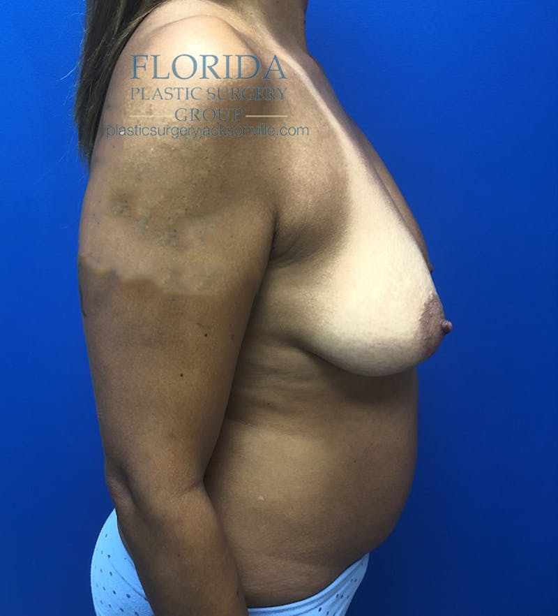 Augmentation Mastopexy Before & After Gallery - Patient 154948739 - Image 5