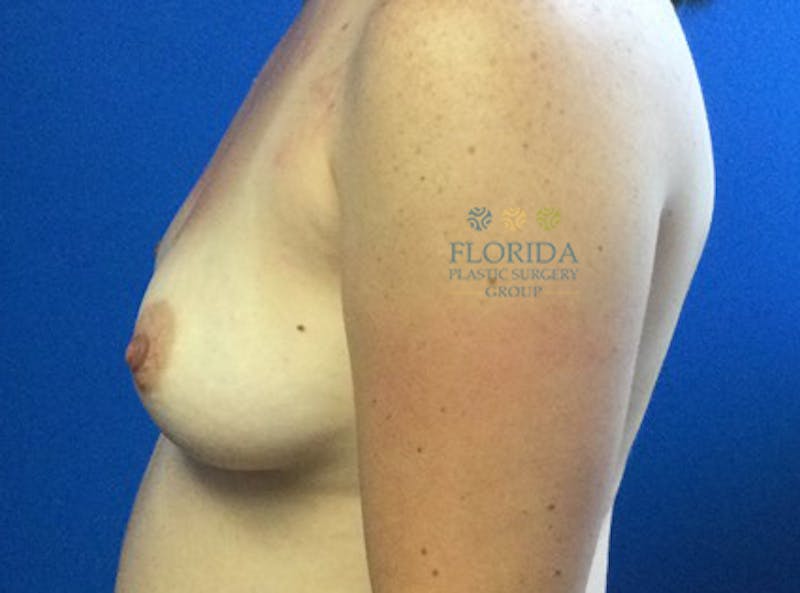 Saline Breast Augmentation Before & After Gallery - Patient 154948743 - Image 3