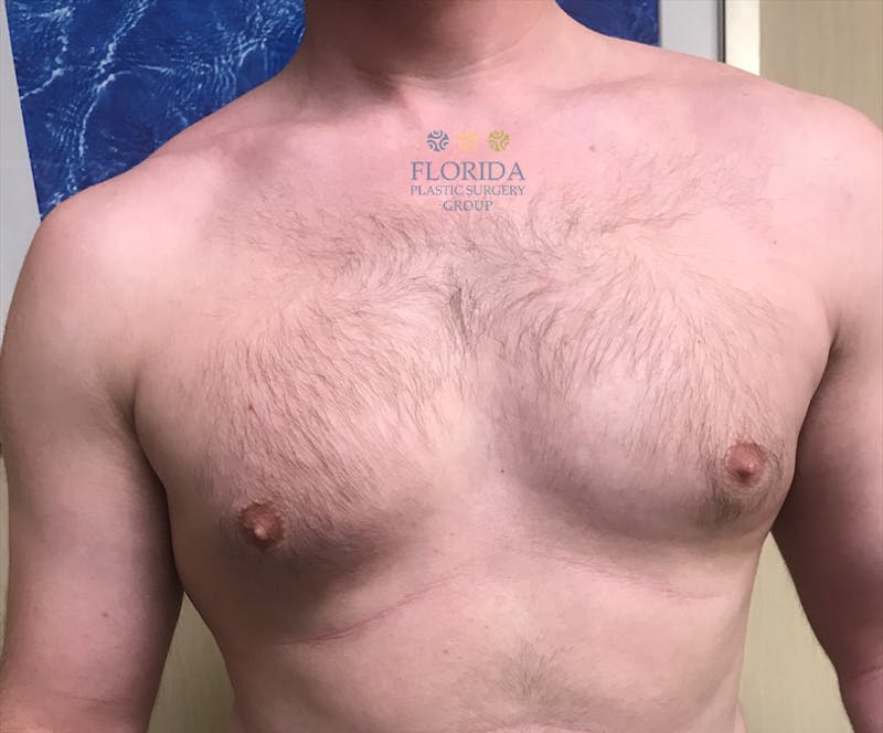 Male Breast Reduction Before & After Gallery - Patient 154948742 - Image 1