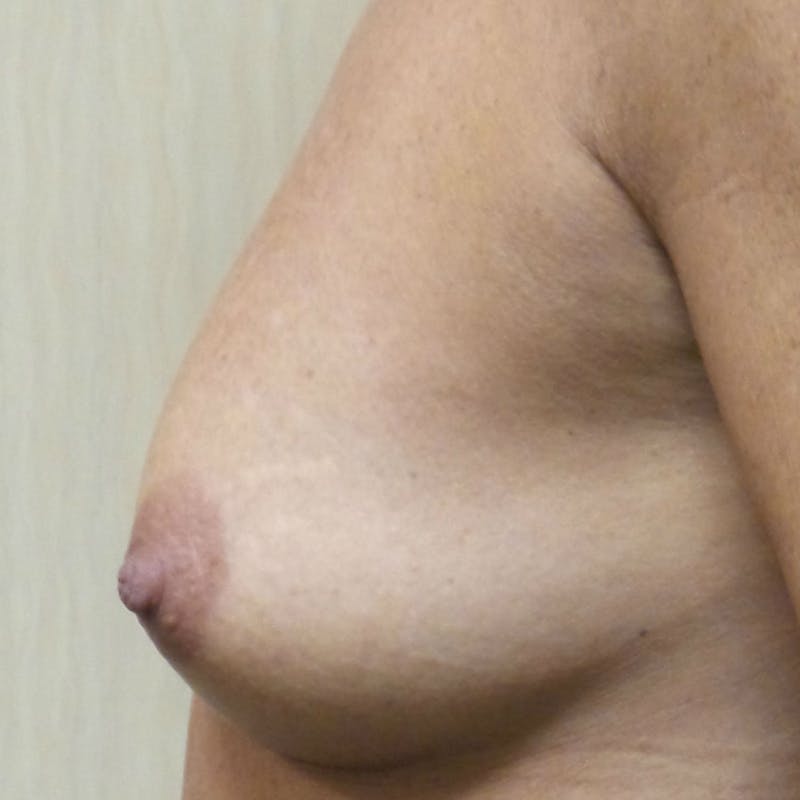 Silicone Breast Augmentation Before & After Gallery - Patient 154948740 - Image 9