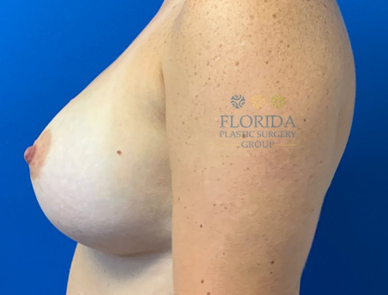 Saline Breast Augmentation Before & After Gallery - Patient 154948743 - Image 4
