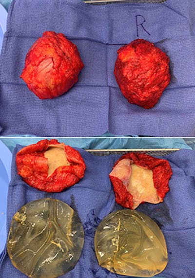 Breast Implant Removal Before & After Gallery - Patient 154948741 - Image 2