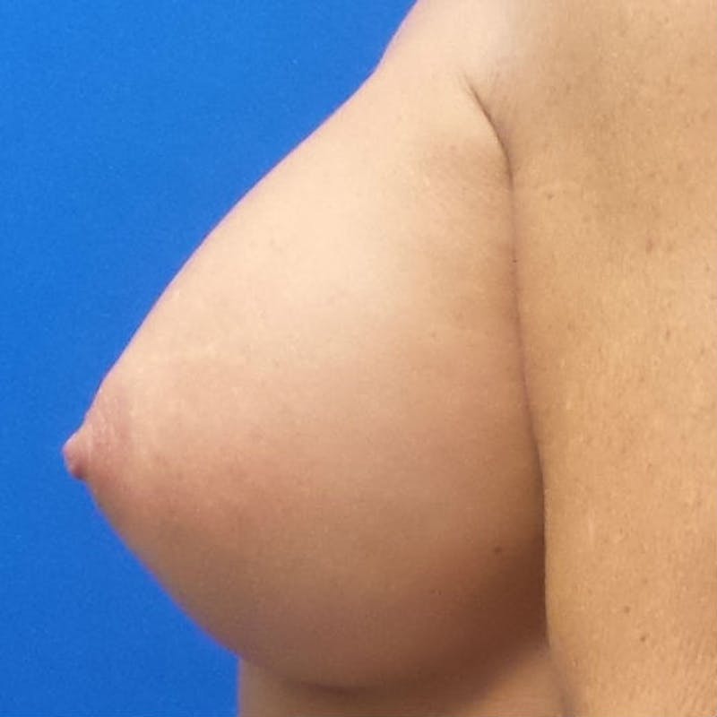 Silicone Breast Augmentation Before & After Gallery - Patient 154948740 - Image 10