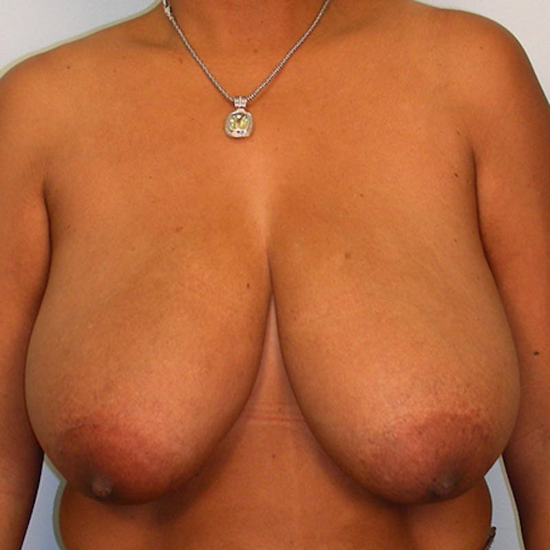 Breast Lift Before & After Gallery - Patient 154948746 - Image 1