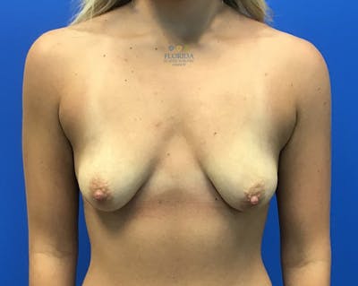 Augmentation Mastopexy Before & After Gallery - Patient 154948749 - Image 1