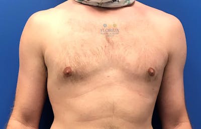 Male Breast Reduction Before & After Gallery - Patient 154948742 - Image 2