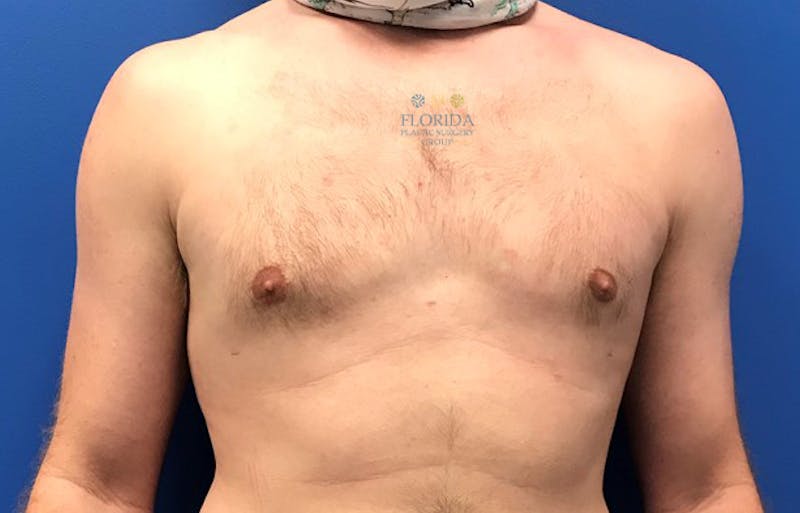 Male Breast Reduction Before & After Gallery - Patient 154948742 - Image 2
