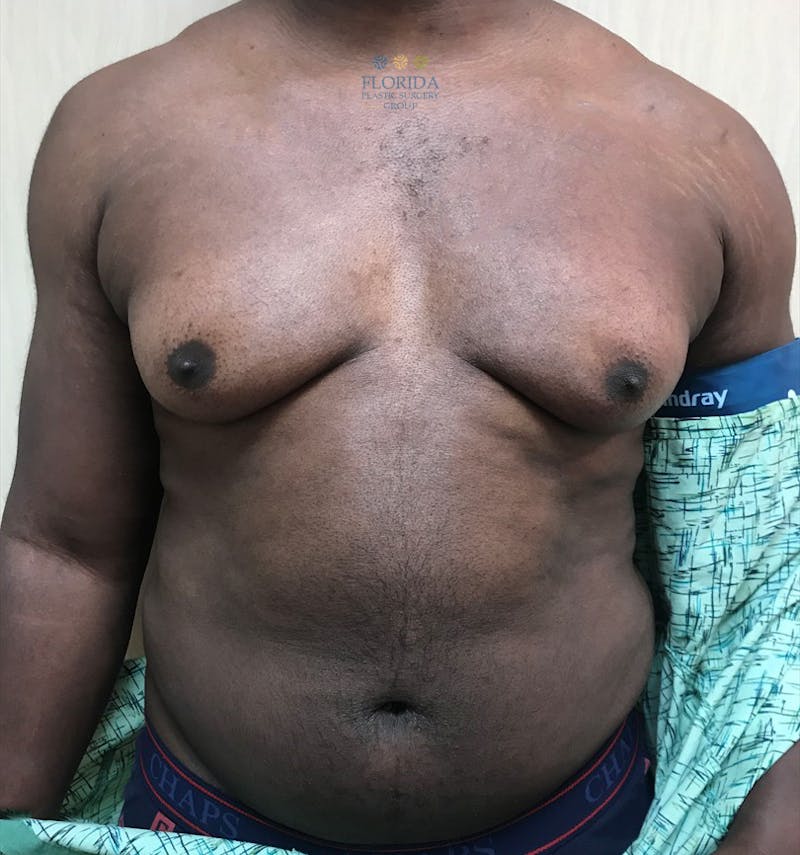 Male Breast Reduction Before & After Gallery - Patient 154948748 - Image 1