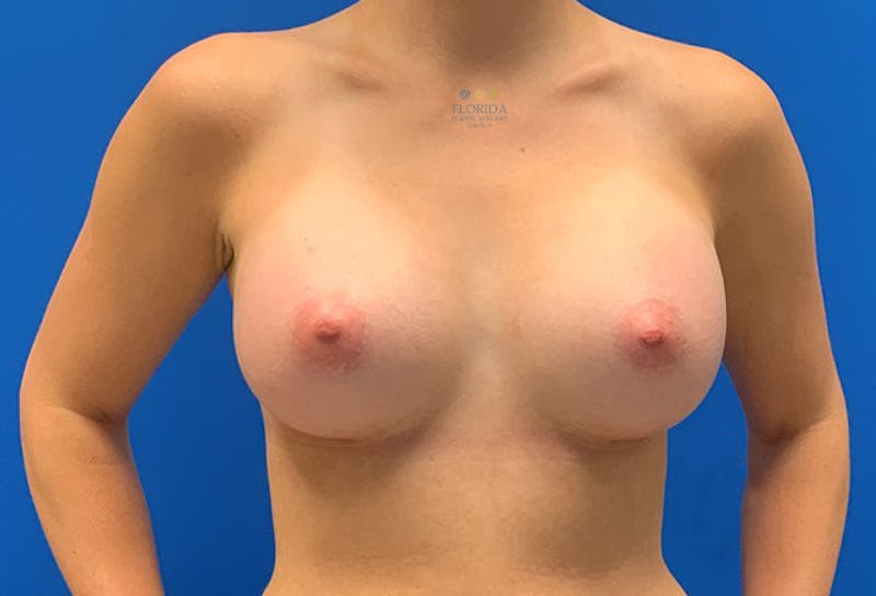 Silicone Breast Augmentation Before & After Gallery - Patient 154948744 - Image 2