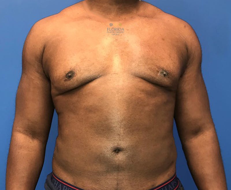 Male Breast Reduction Before & After Gallery - Patient 154948748 - Image 2