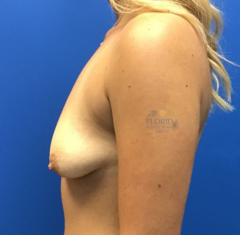 Augmentation Mastopexy Before & After Gallery - Patient 154948749 - Image 5