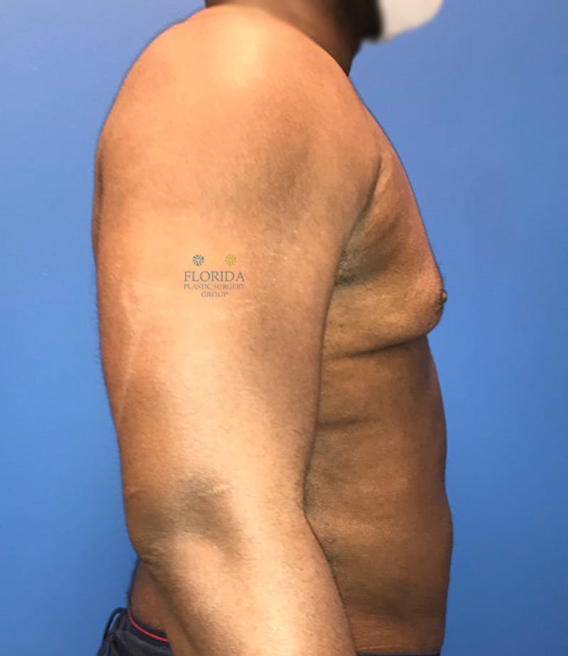 Male Breast Reduction Before & After Gallery - Patient 154948748 - Image 4