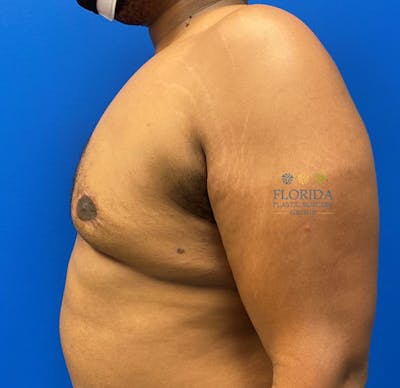 Male Breast Reduction Before & After Gallery - Patient 154948757 - Image 2