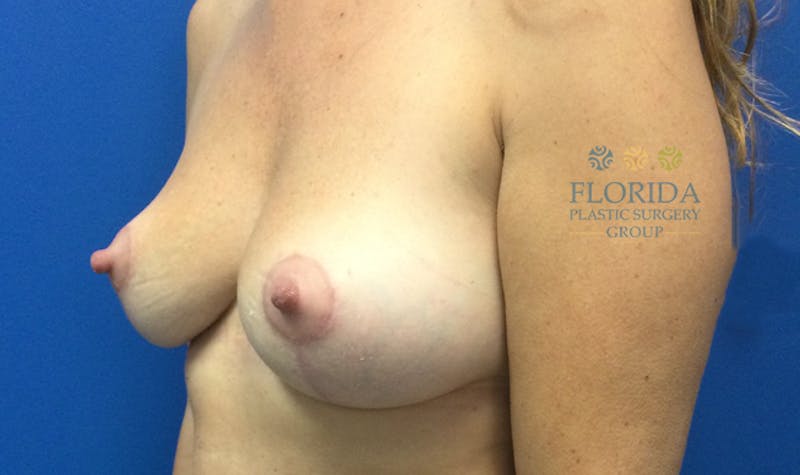 Breast Lift Before & After Gallery - Patient 154948755 - Image 4