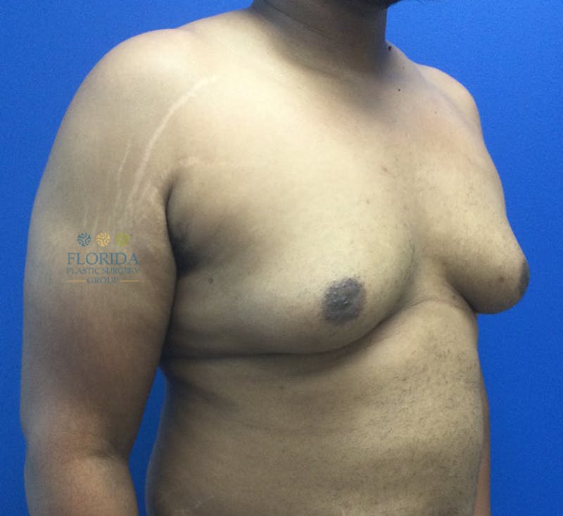 Male Breast Reduction Before & After Gallery - Patient 154948757 - Image 3