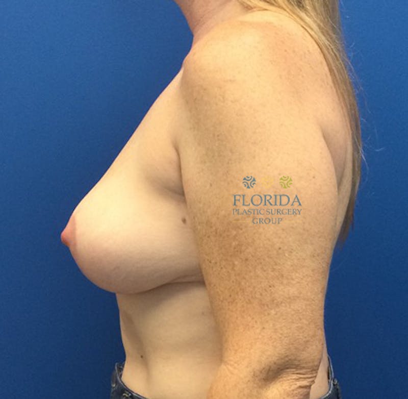 Breast Implant Removal Before & After Gallery - Patient 154948760 - Image 2