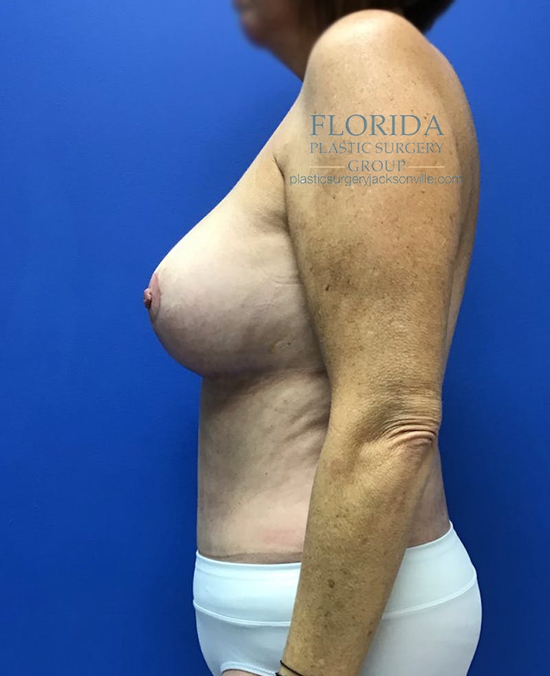 Breast Reduction Before & After Gallery - Patient 154948754 - Image 8