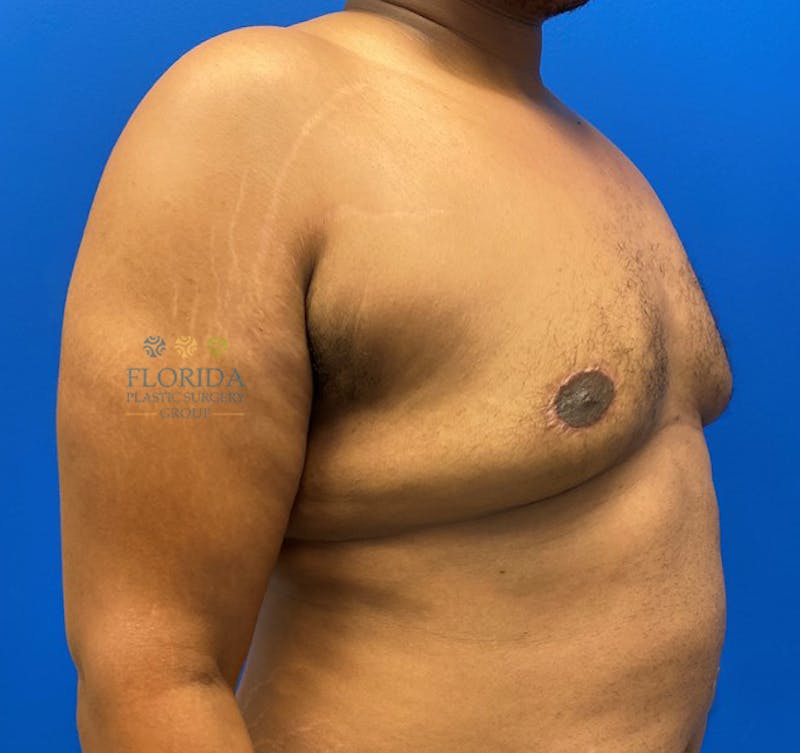 Male Breast Reduction Before & After Gallery - Patient 154948757 - Image 4