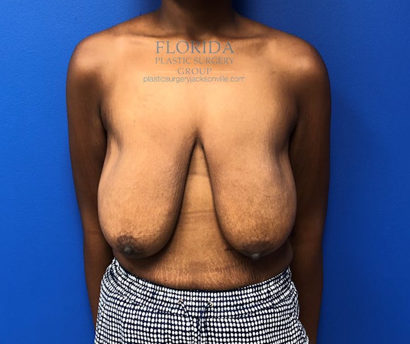 Breast Lift Before & After Gallery - Patient 154948769 - Image 1