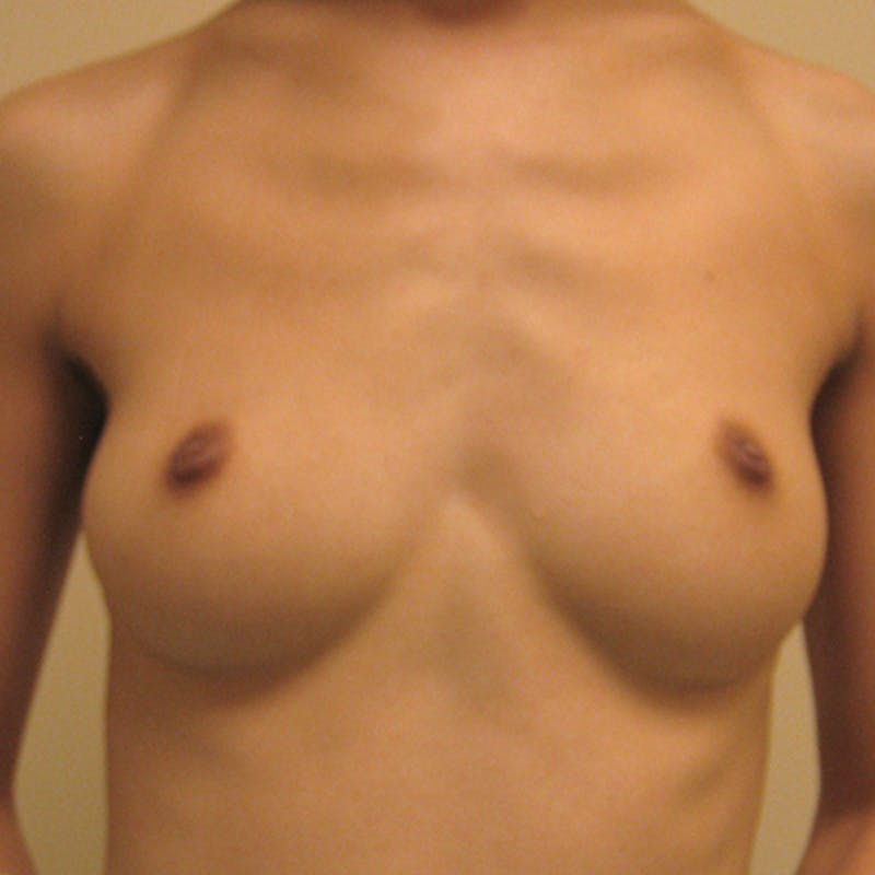 Silicone Breast Augmentation Before & After Gallery - Patient 154948765 - Image 1