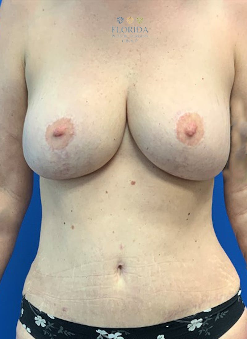DIEP Flap Reconstruction Before & After Gallery - Patient 154948758 - Image 2