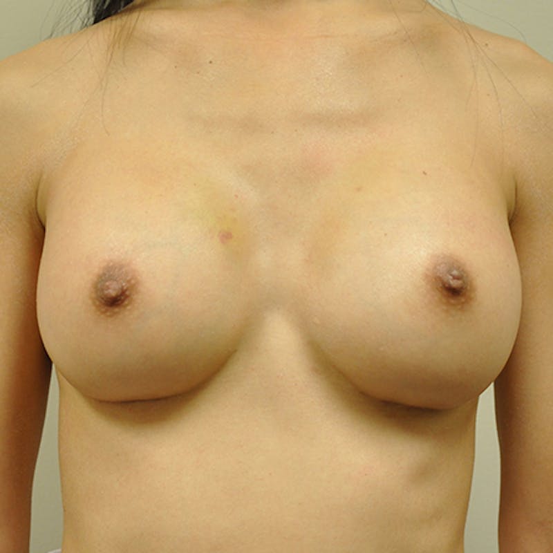 Silicone Breast Augmentation Before & After Gallery - Patient 154948765 - Image 2