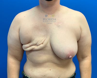 DIEP Flap Reconstruction Before & After Gallery - Patient 154948770 - Image 1